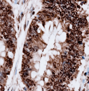 Image: Fluorescenated Hsa-miR-21 probe fused for localization of miRNA in formalin-fixed paraffin-embedded tissue by in situ hybridization (Photo courtesy of BioGenex laboratories).